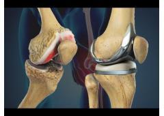 Top Knee Replacement Surgeon in Vaishali Nagar – Dr. Arvind Asopa